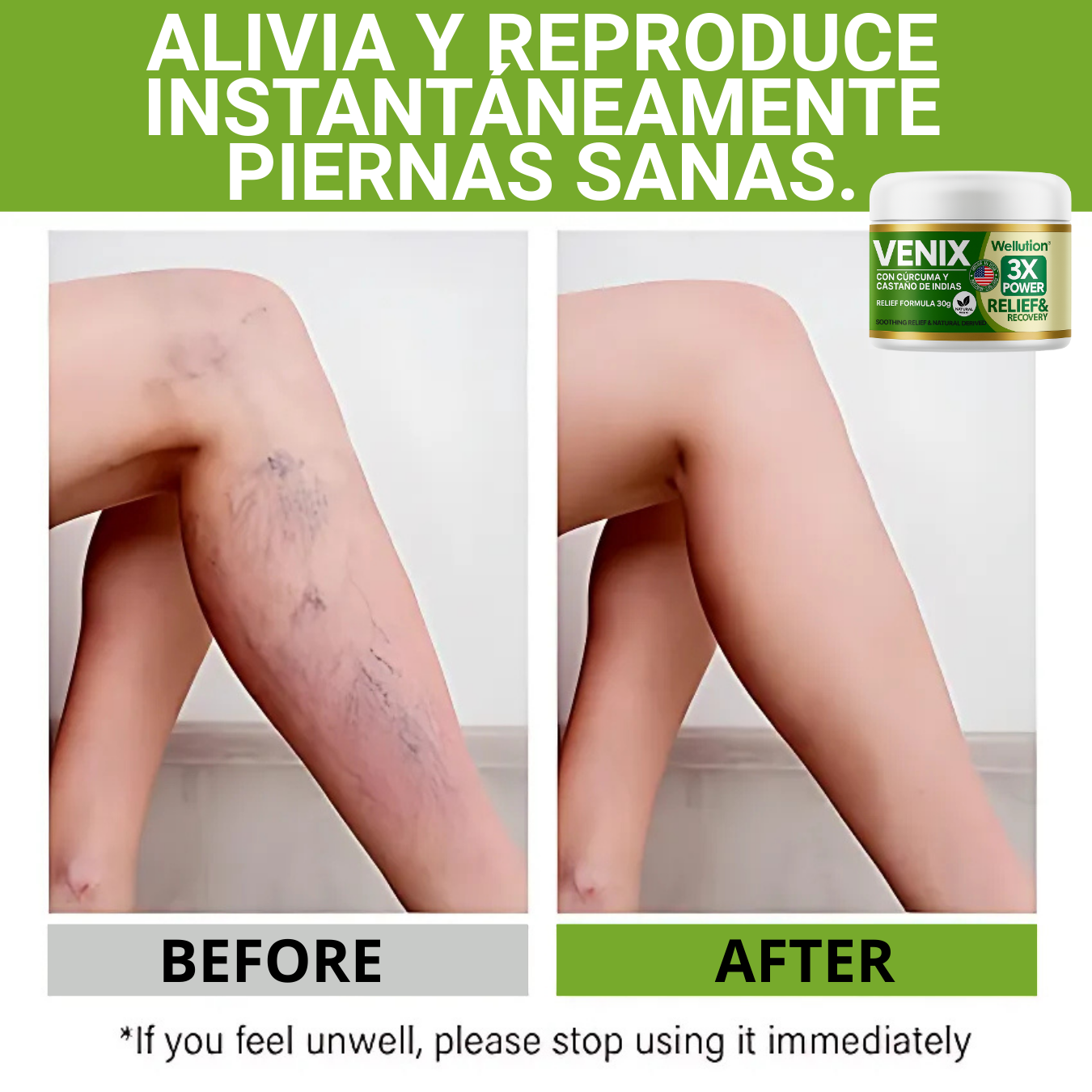 Crema VENIX - Alivia el dolor de varices